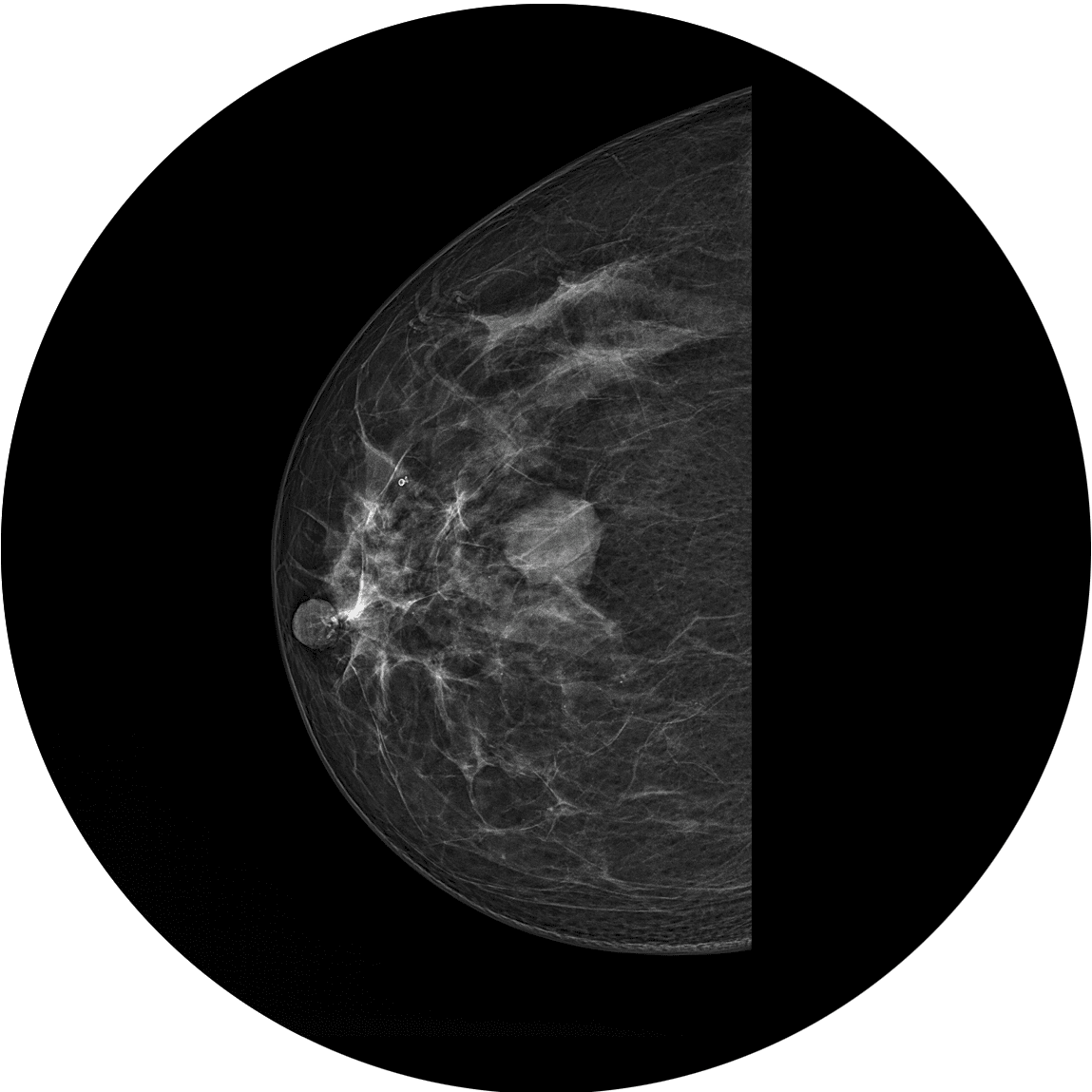 ماموگرافی BI-RADS 1 و BI-RADS 2