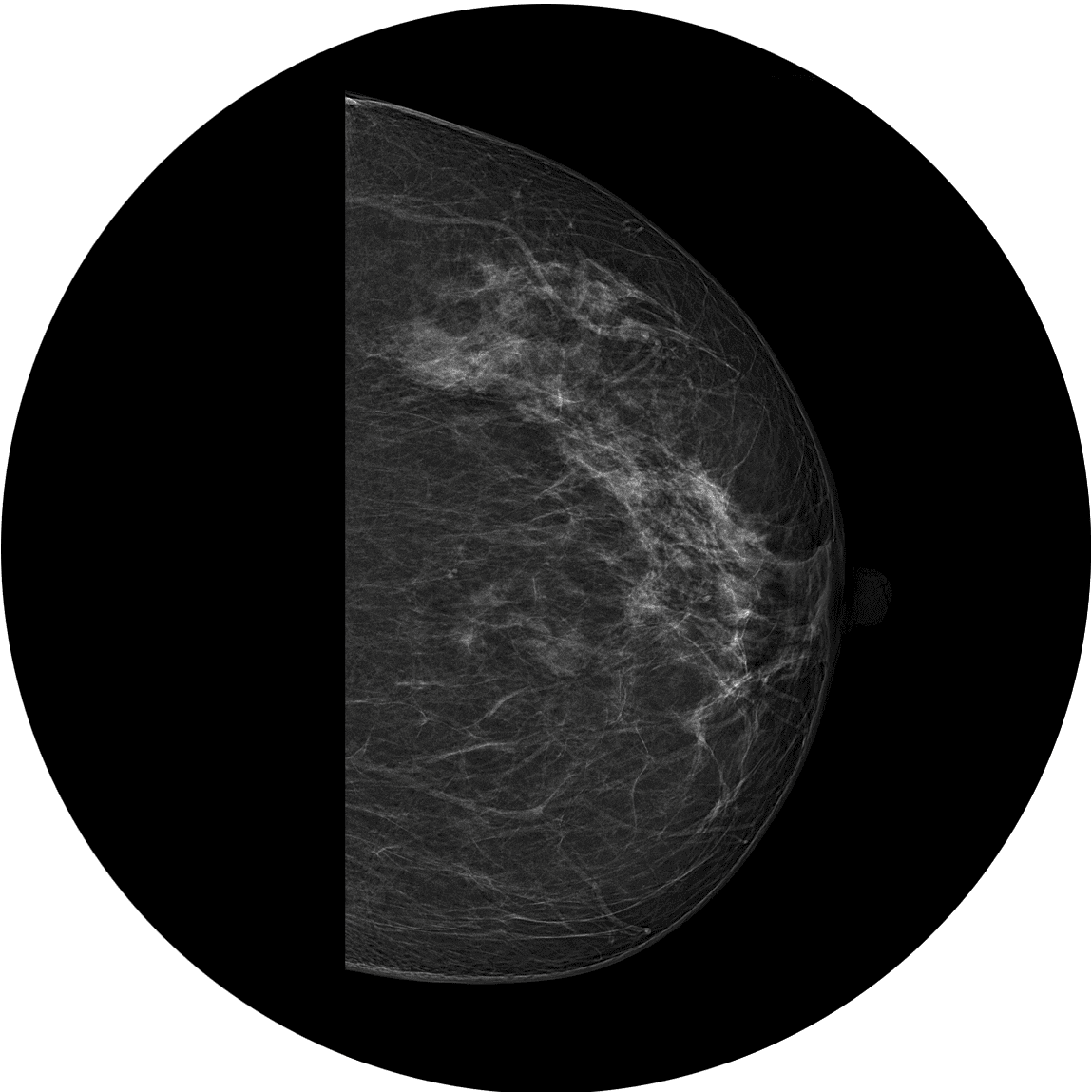 ماموگرافی BI-RADS 2