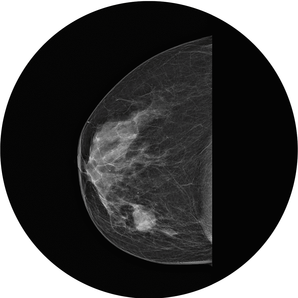 ماموگرافی BI-RADS 3 و BI-RADS 4