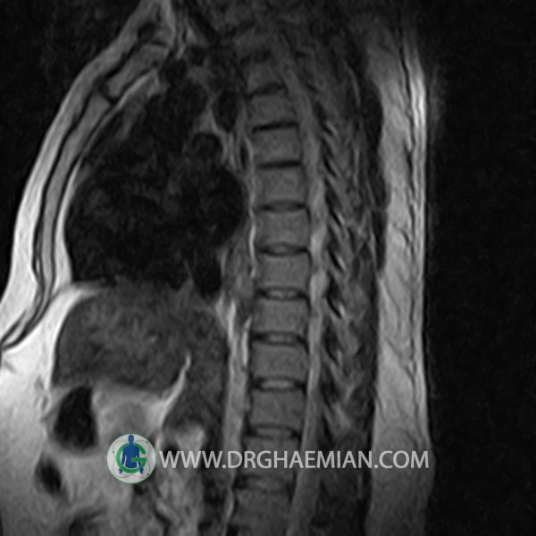ام آر آی اسپوندیلوز توراسیک بیمار