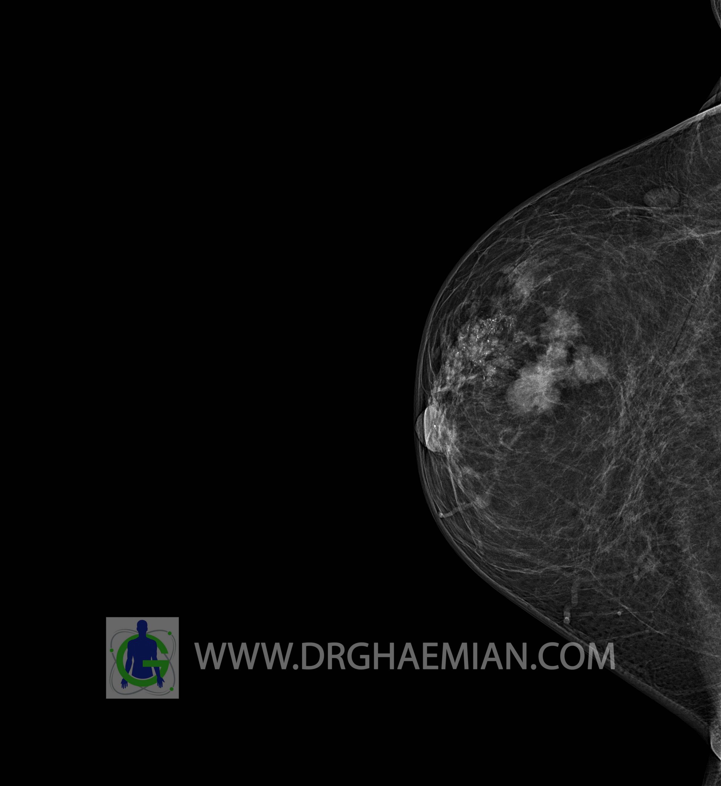 ماموگرافی BI-RADS 4C بیمار