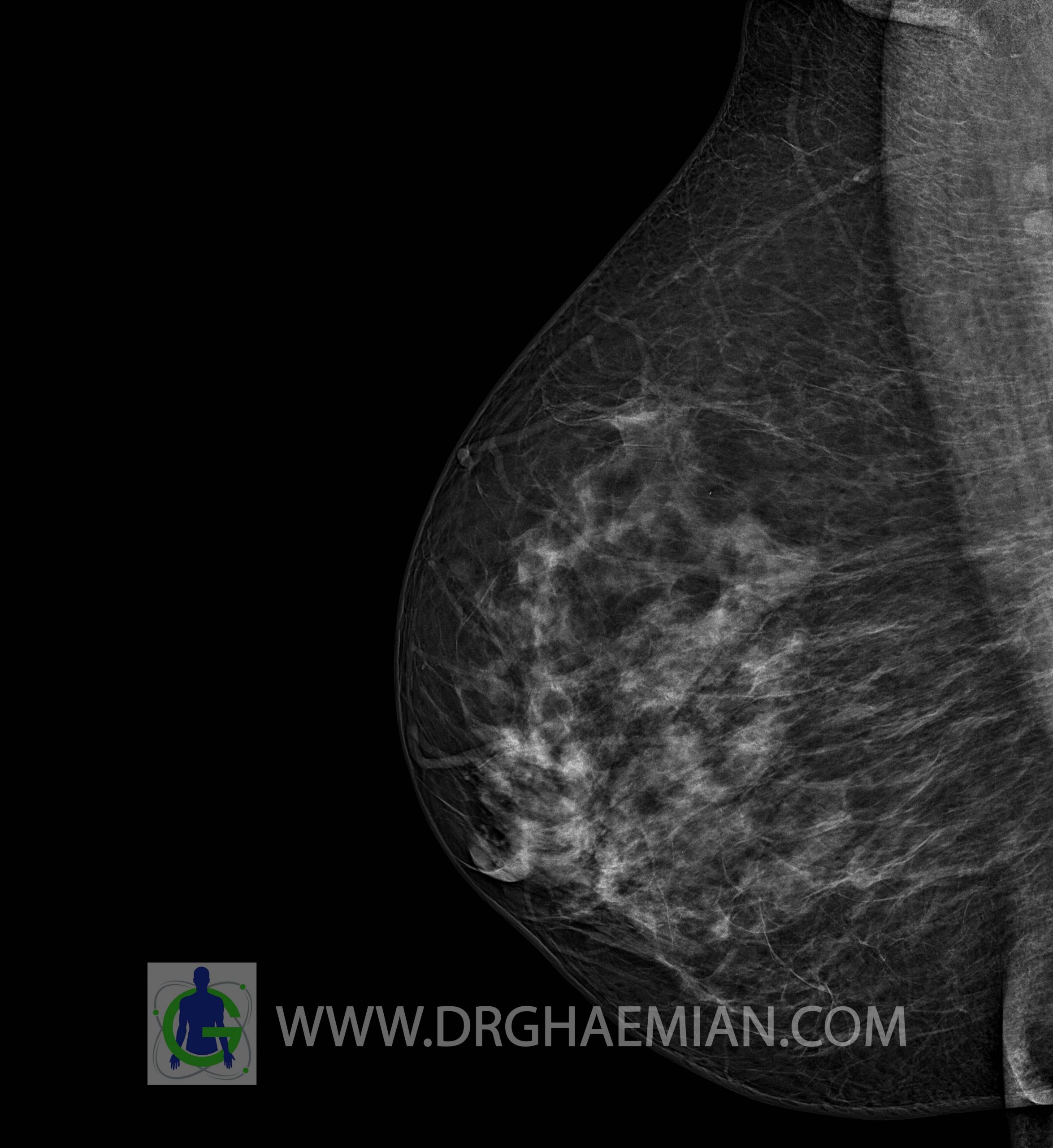 ماموگرافی BI-RADS 3 بیمار