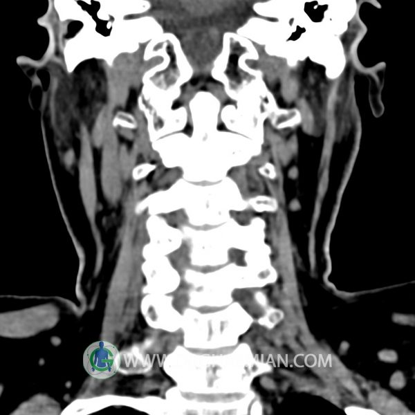 سی تی اسکن توده نئوپلازیک گردن