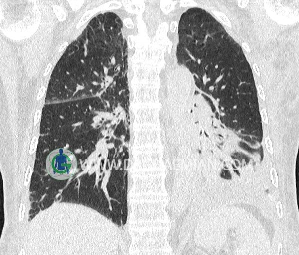 سی تی اسکن لنفانژيت کارسينوماتوز ریه