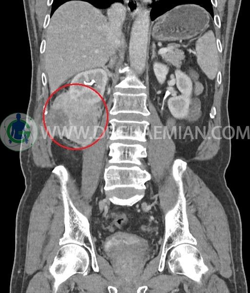سی تی اسکن توده کلیه