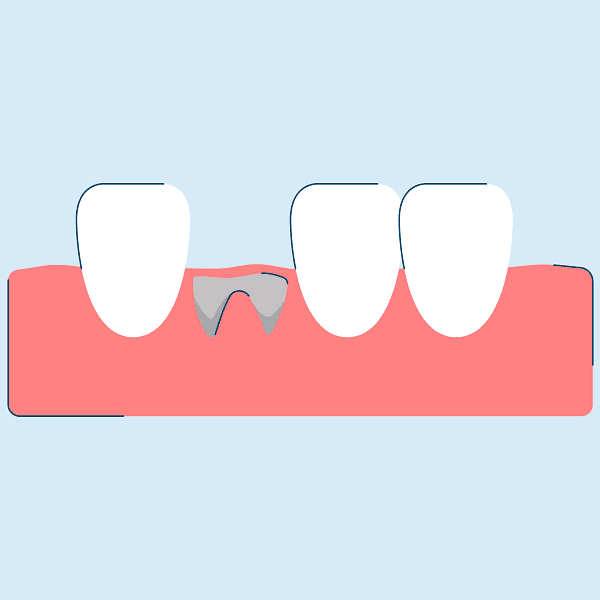 همه چیز درباره استئیت آلوئولی : علائم این بیماری چیست؟ روش های درمانی آن کدامند؟استئیت آلوئولی را چگونه تشخیص می دهند؟ و ...