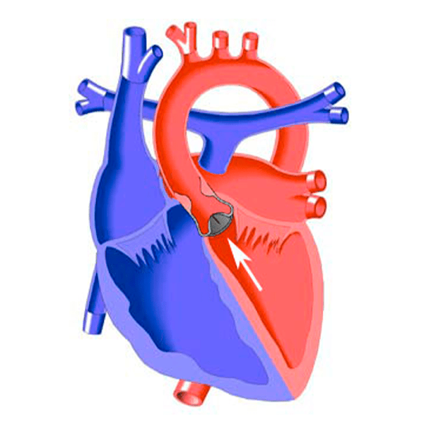 Aortic Stenosis