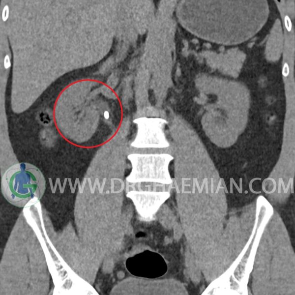 سی تی هیدرونفروز کلیه