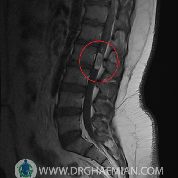 در این کیس تومور نخاعی تومور اپاندیموم به ابعاد 11*25 میلی متر و از بین رفتن کامل فضای CSF  و ... دیده میشود