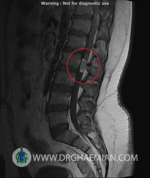 در این کیس تومور نخاعی تومور اپاندیموم به ابعاد 11*25 میلی متر و از بین رفتن کامل فضای CSF  و ... دیده میشود